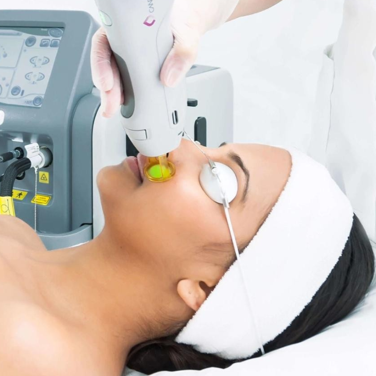 candella-laser-hair-removal